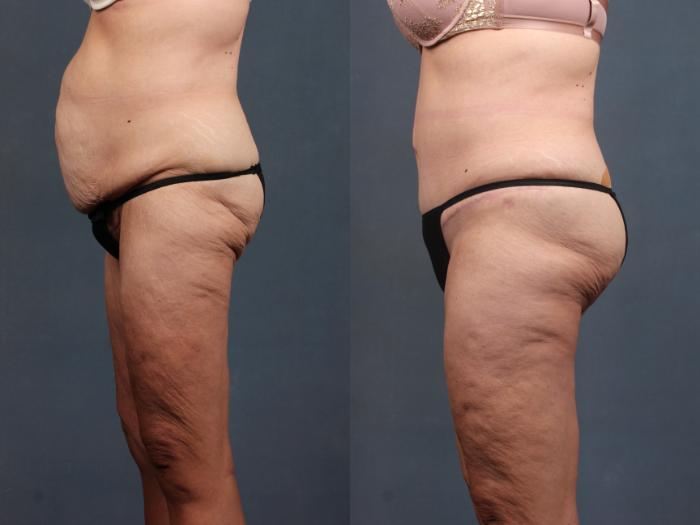 Before & After Tummy Tuck Case 569 View #2 View in Louisville & Lexington, KY