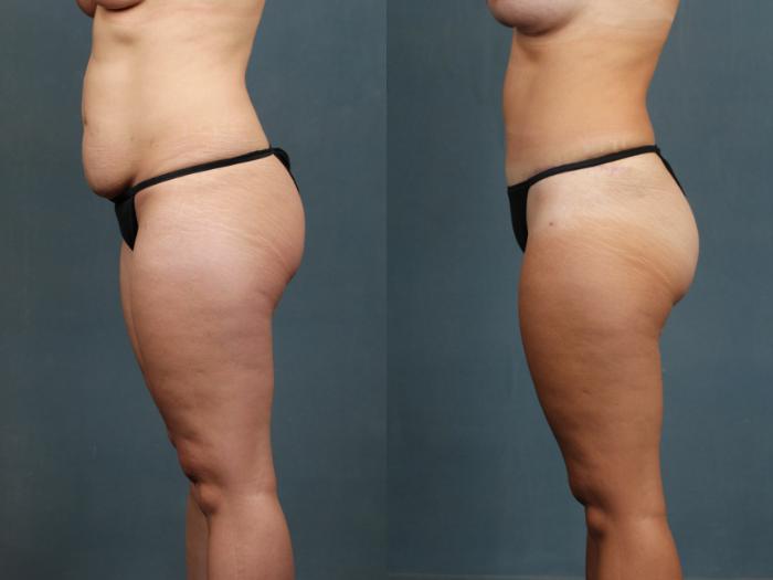 Before & After Tummy Tuck Case 588 View #1 View in Louisville & Lexington, KY