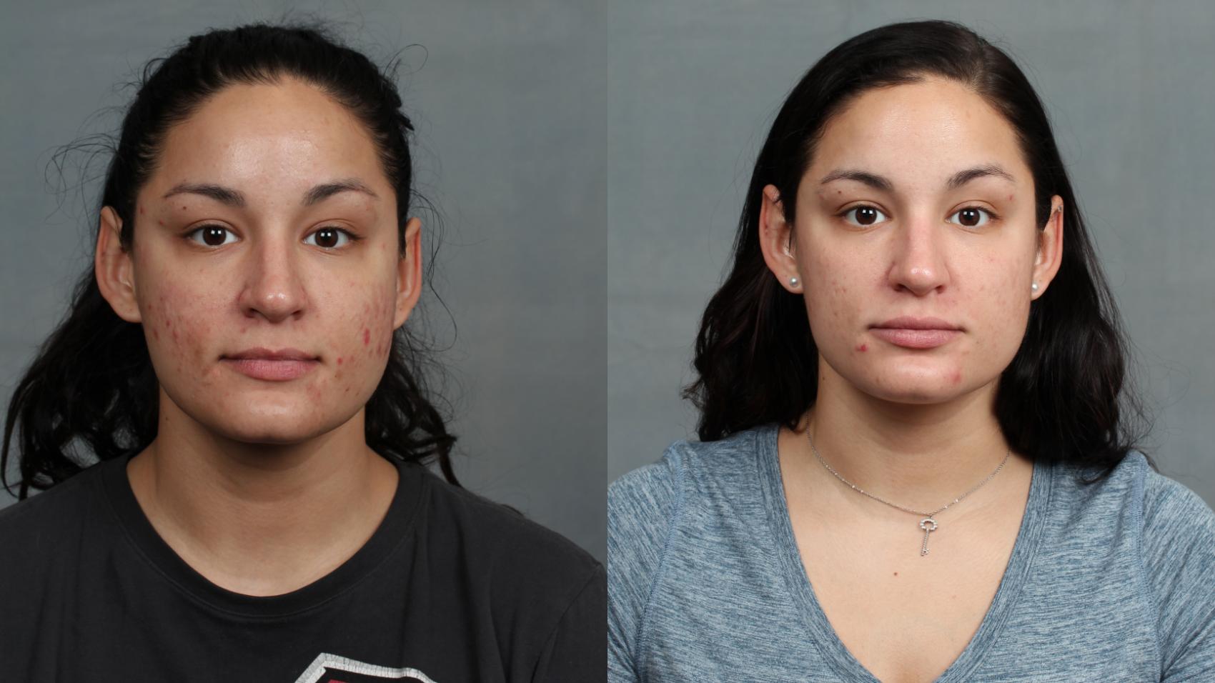 Before & After Advanced Medical Facials Case 676 Front View in Louisville, KY