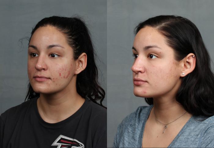 Before & After Advanced Medical Facials Case 676 Left Oblique View in Louisville & Lexington, KY