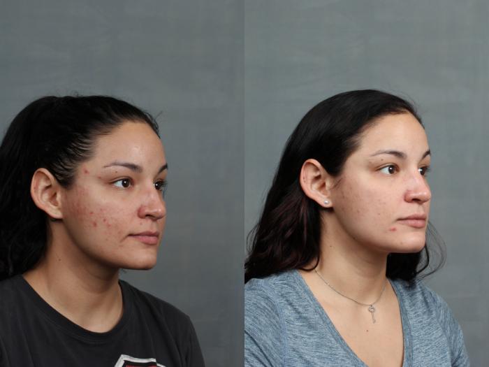 Before & After Advanced Medical Facials Case 676 Right Oblique View in Louisville & Lexington, KY