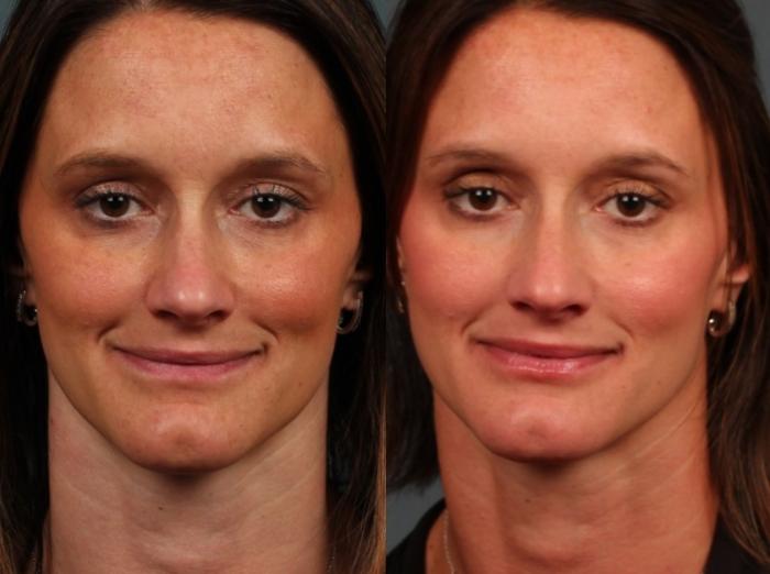 Before & After Advanced Medical Facials Case 677 Front View in Louisville & Lexington, KY