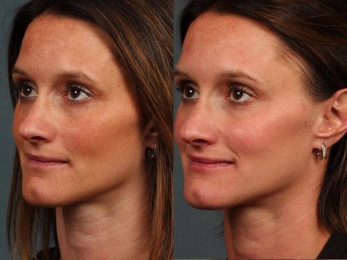 Before & After Advanced Medical Facials Case 677 Right Oblique View in Louisville & Lexington, KY