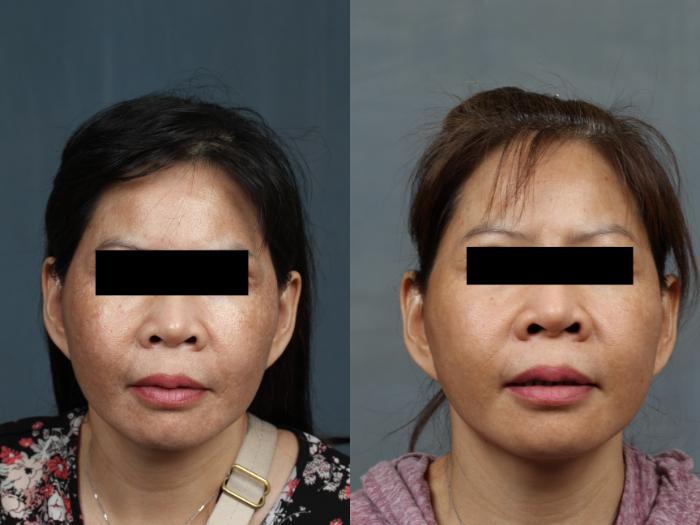 Before & After Advanced Medical Facials Case 678 Front View in Louisville & Lexington, KY