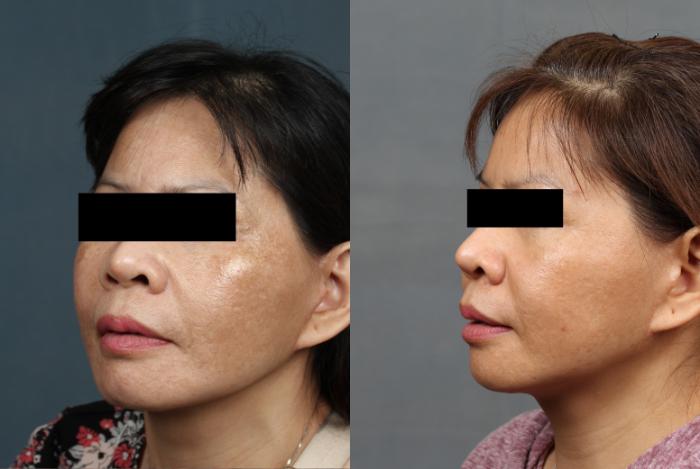 Before & After Advanced Medical Facials Case 678 Right Oblique View in Louisville & Lexington, KY