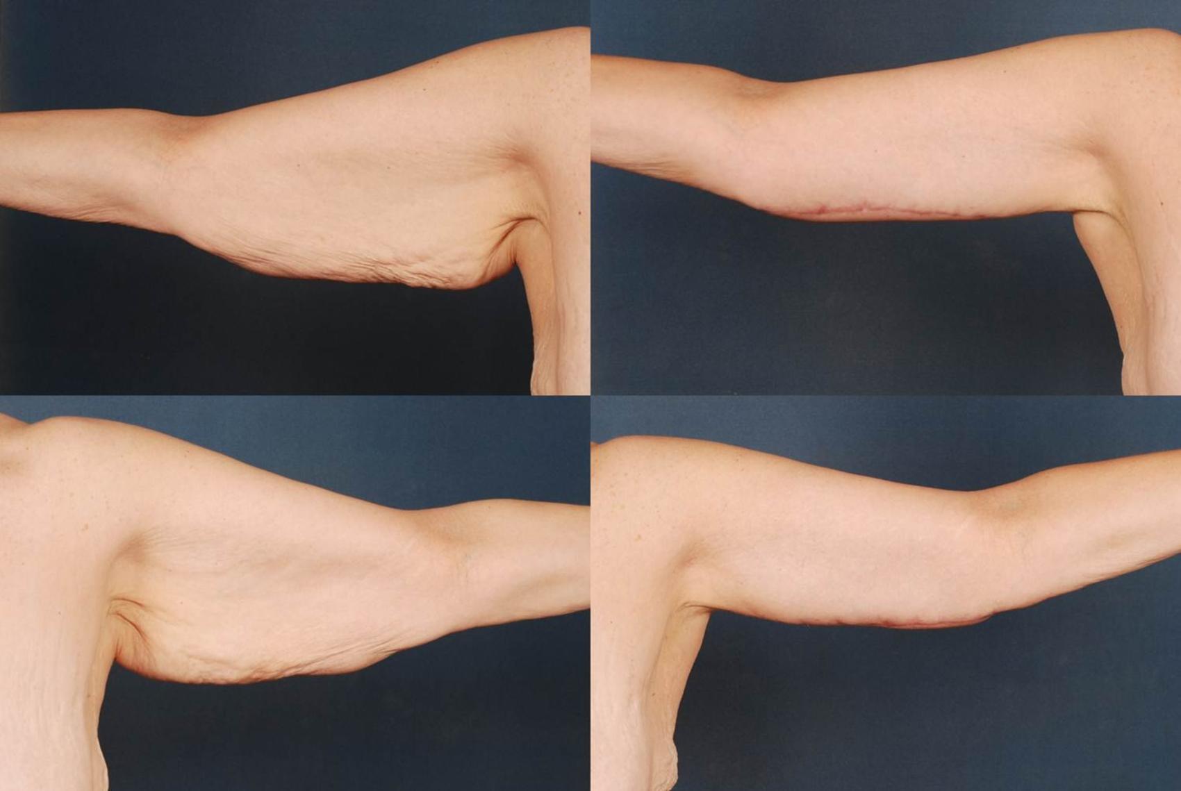Arm Lift Case 231 Before & After View #1 | Louisville, KY | CaloSpa® Rejuvenation Center