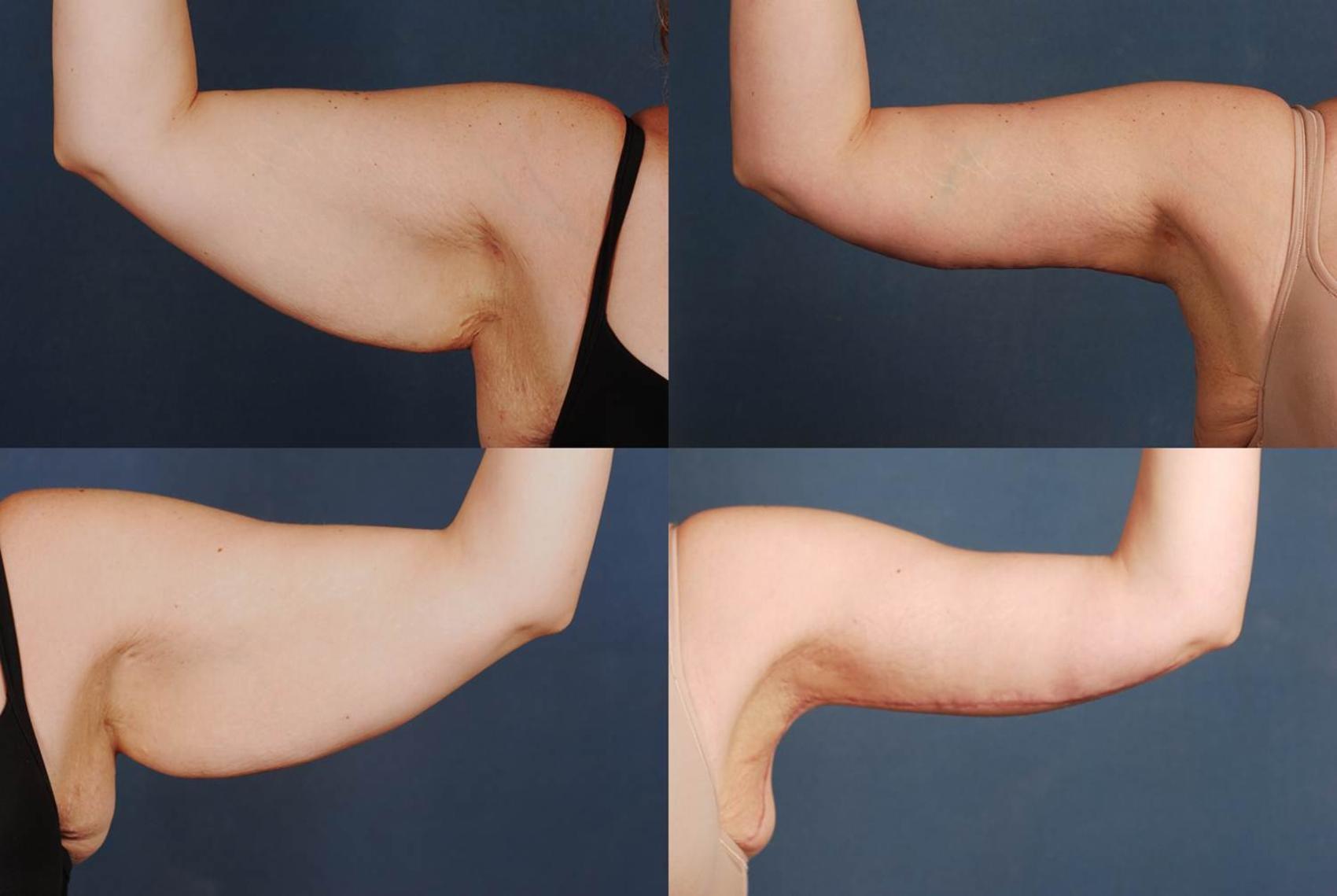 Before & After Arm Lift Case 233 View #1 View in Louisville & Lexington, KY