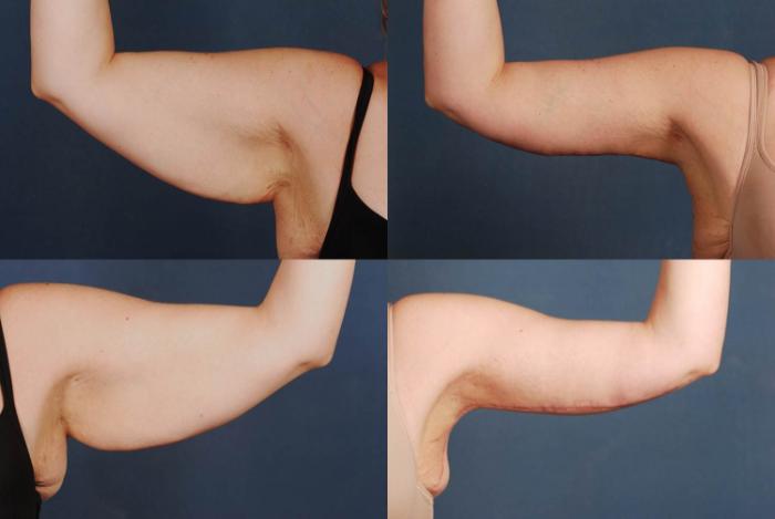 Arm Lift Case 233 Before & After View #1 | Louisville, KY | CaloSpa® Rejuvenation Center