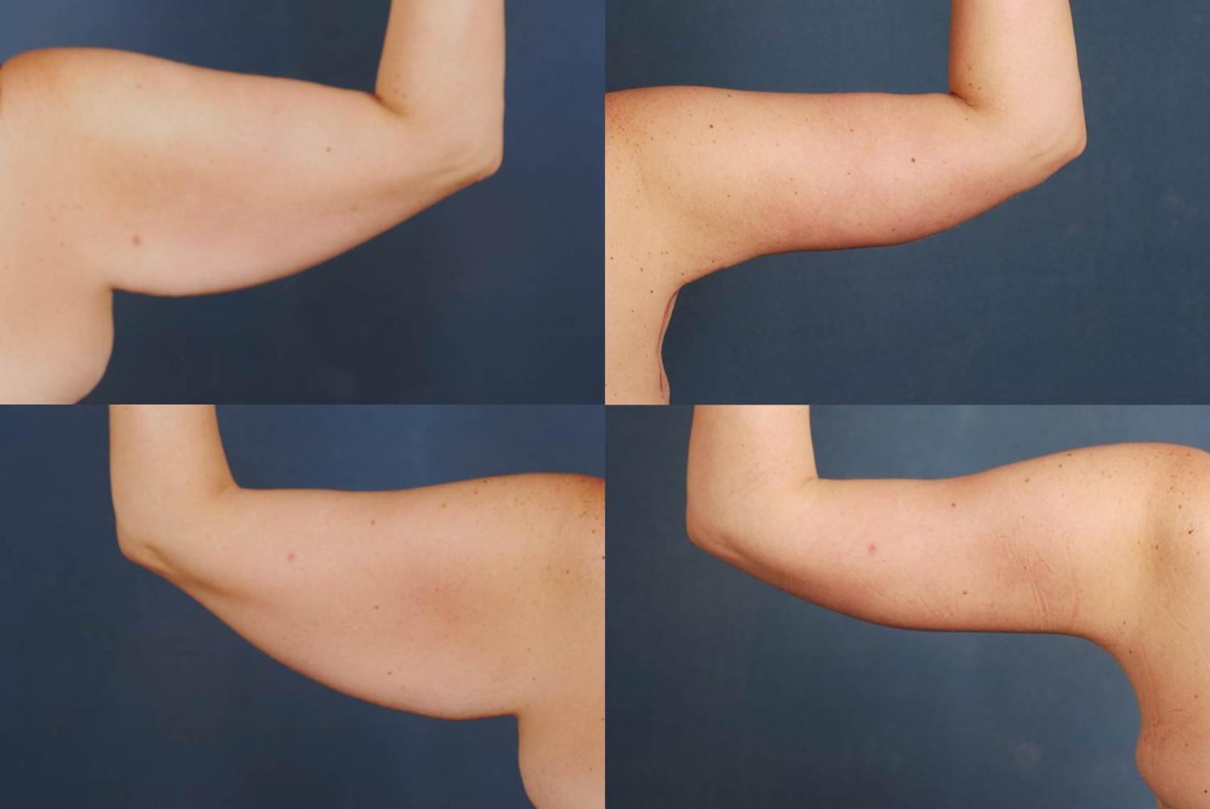 Before & After Arm Lift Case 233 View #2 View in Louisville & Lexington, KY