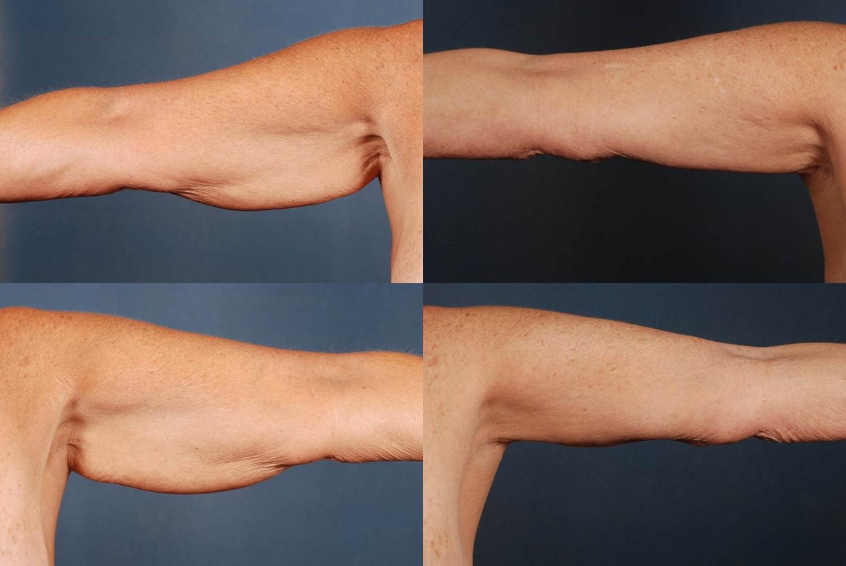 Arm Lift Case 234 Before & After View #1 | Louisville, KY | CaloSpa® Rejuvenation Center