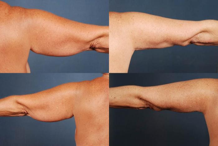Before & After Arm Lift Case 234 View #2 View in Louisville & Lexington, KY