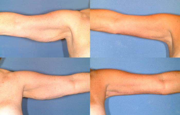 Before & After Arm Lift Case 235 View #1 View in Louisville & Lexington, KY