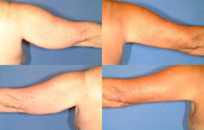 Arm Lift Case 235 Before & After View #2 | Louisville, KY | CaloSpa® Rejuvenation Center
