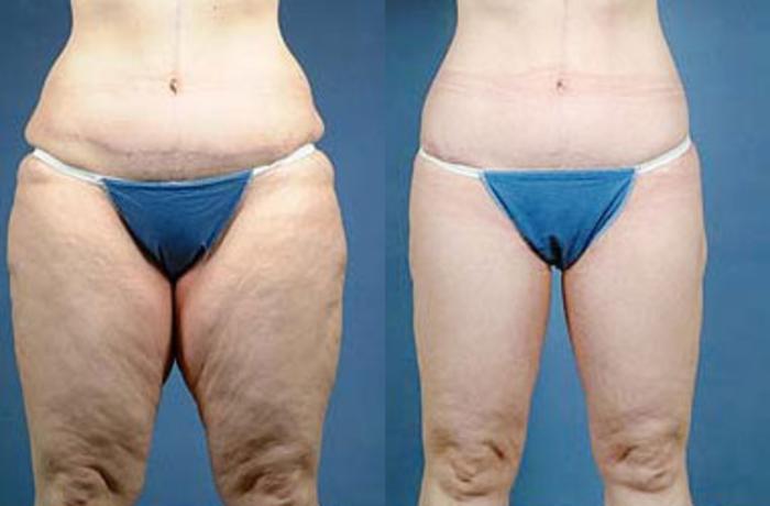 Before & After Body/Thigh Lift Case 137 View #1 View in Louisville & Lexington, KY