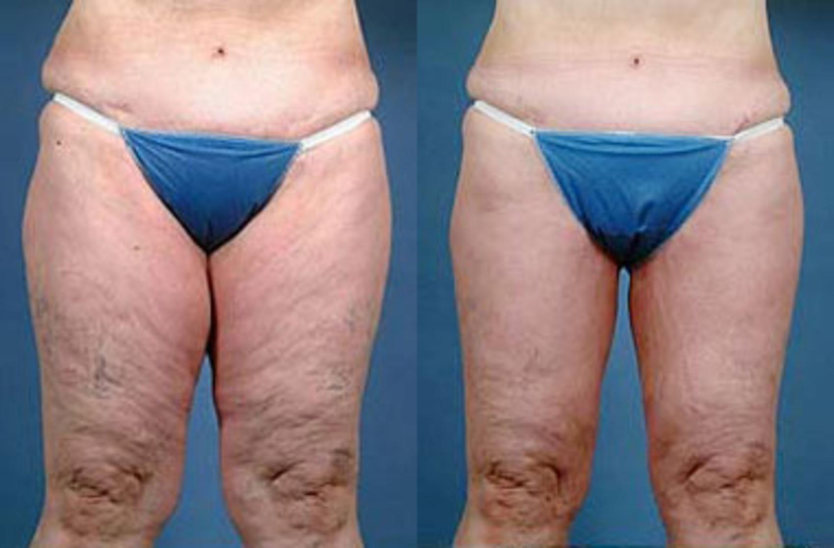 Before & After Body/Thigh Lift Case 138 View #1 View in Louisville, KY