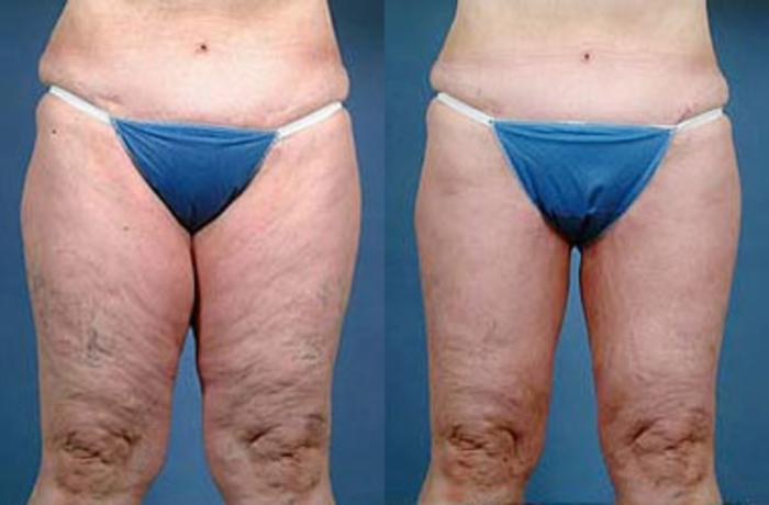 Before & After Body/Thigh Lift Case 138 View #1 View in Louisville & Lexington, KY