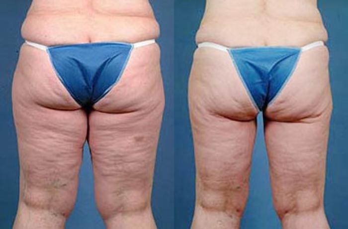 Body/Thigh Lift Case 138 Before & After View #2 | Louisville, KY | CaloSpa® Rejuvenation Center