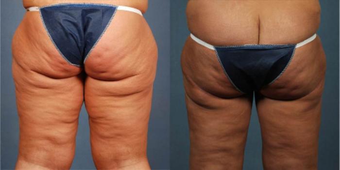 Body/Thigh Lift Case 247 Before & After View #4 | Louisville, KY | CaloSpa® Rejuvenation Center