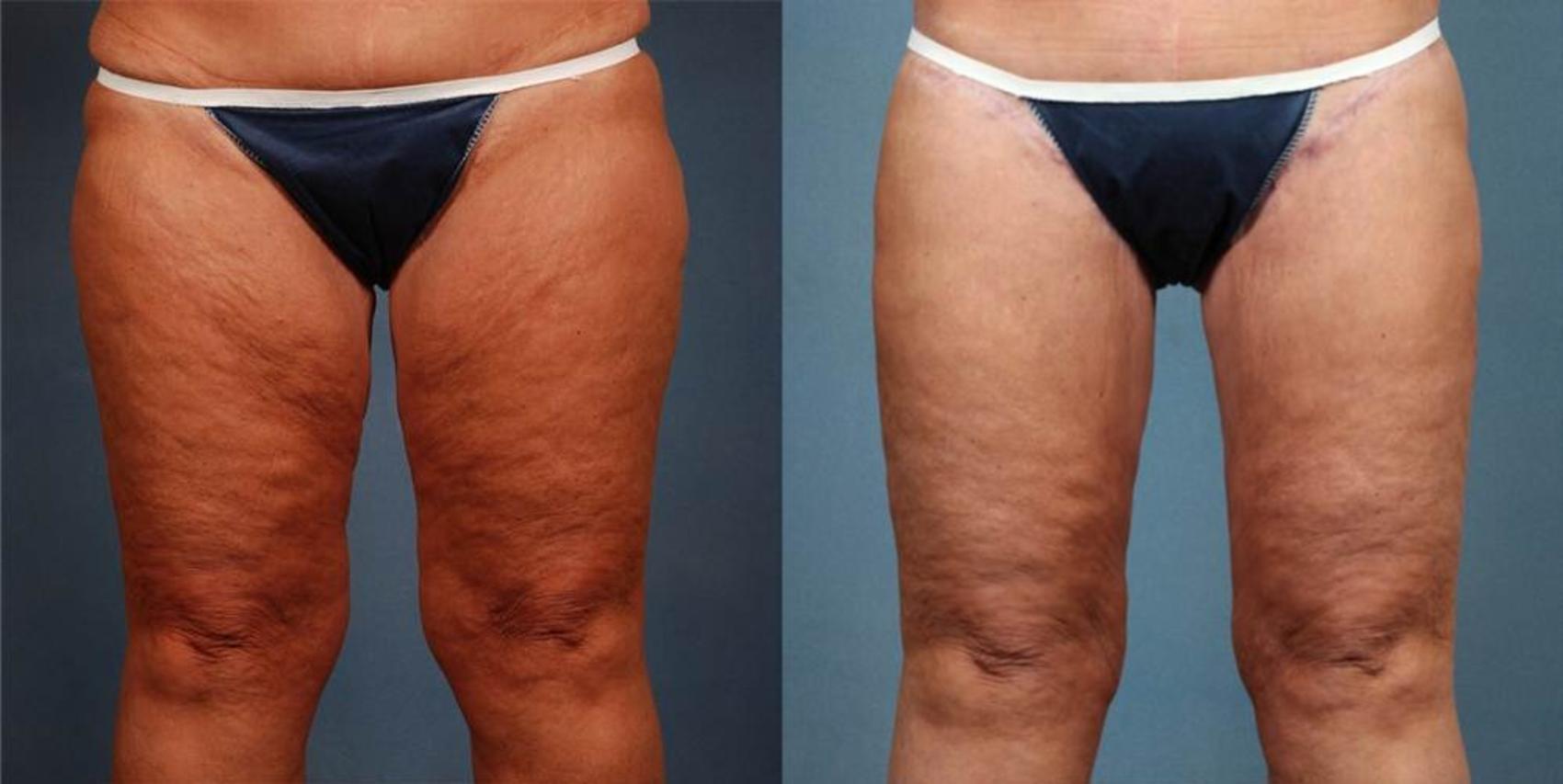 Before & After Body/Thigh Lift Case 248 View #1 View in Louisville & Lexington, KY