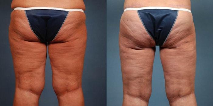 Body/Thigh Lift Case 248 Before & After View #2 | Louisville, KY | CaloSpa® Rejuvenation Center
