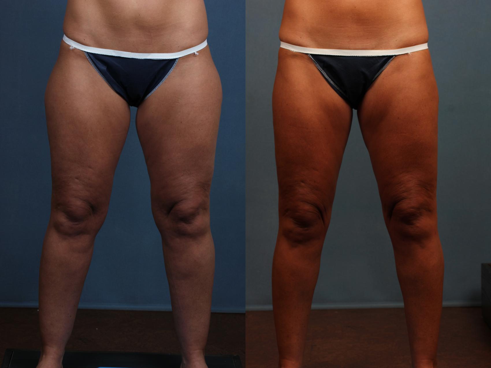 Before & After Body/Thigh Lift Case 571 View #1 View in Louisville, KY