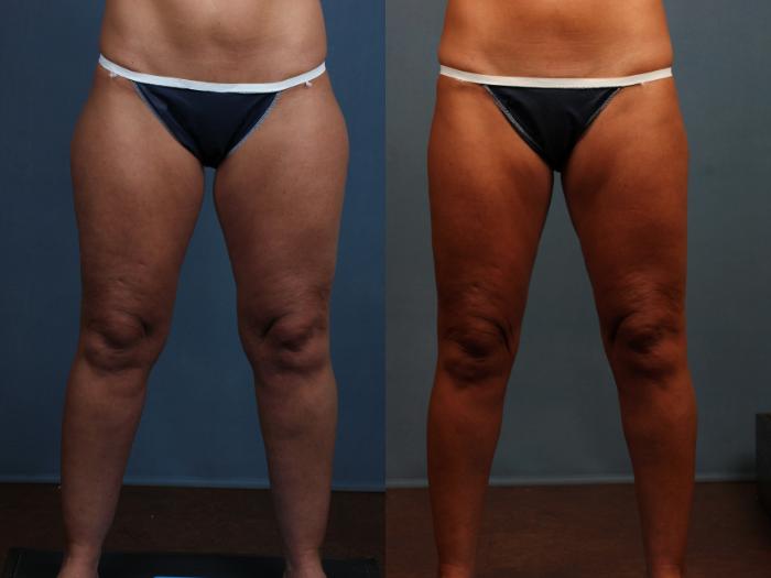 Before & After Body/Thigh Lift Case 571 View #1 View in Louisville & Lexington, KY