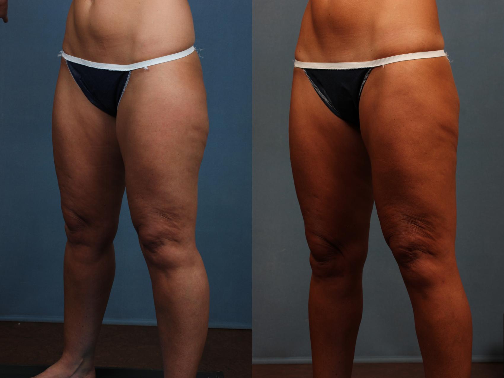 Before & After Body/Thigh Lift Case 571 View #2 View in Louisville & Lexington, KY