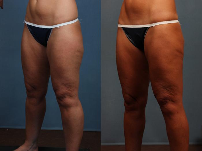 Body/Thigh Lift Case 571 Before & After View #2 | Louisville, KY | CaloSpa® Rejuvenation Center