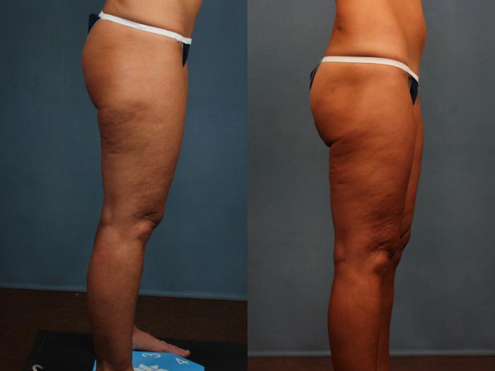 Body/Thigh Lift Case 571 Before & After View #3 | Louisville, KY | CaloSpa® Rejuvenation Center