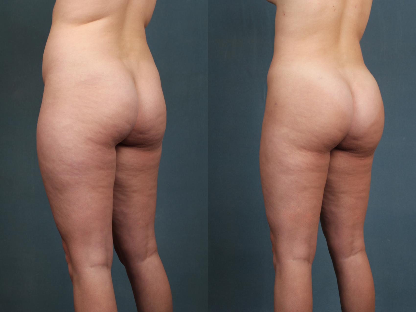 Before & After Brazilian Butt Lift Case 594 View #2 View in Louisville & Lexington, KY
