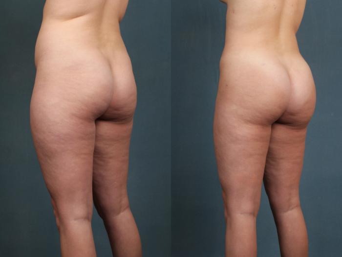 Brazilian Butt Lift Case 594 Before & After View #2 | Louisville, KY | CaloSpa® Rejuvenation Center