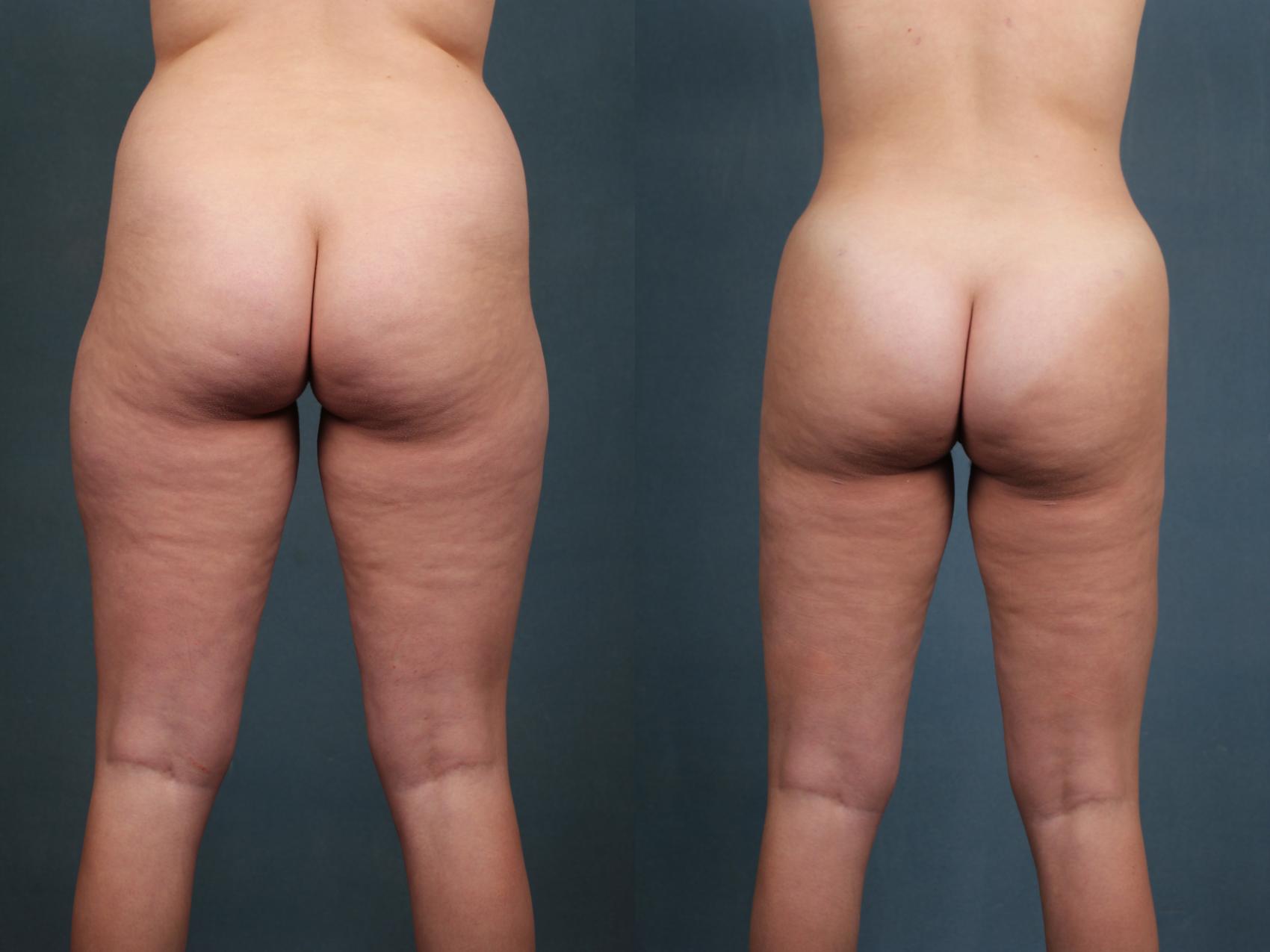 Before & After Brazilian Butt Lift Case 594 View #3 View in Louisville & Lexington, KY