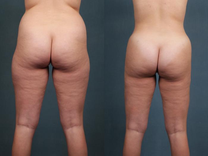 Brazilian Butt Lift Case 594 Before & After View #3 | Louisville, KY | CaloSpa® Rejuvenation Center