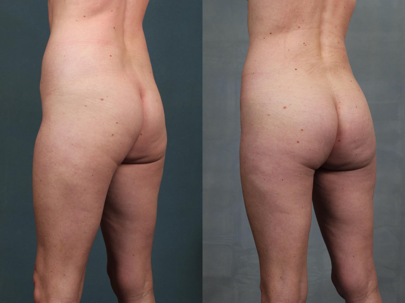 Before & After Brazilian Butt Lift Case 744 Left Oblique View in Louisville & Lexington, KY
