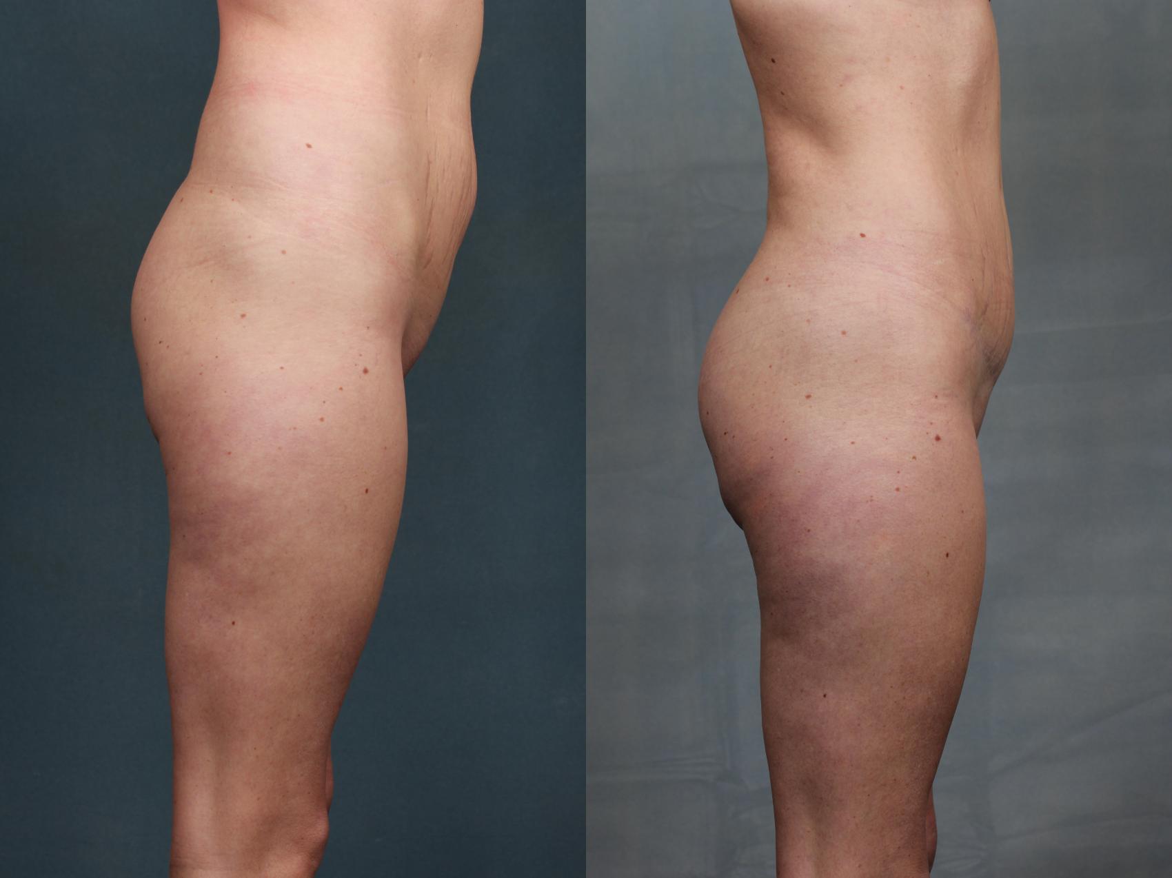 Before & After Brazilian Butt Lift Case 744 Right Side View in Louisville & Lexington, KY