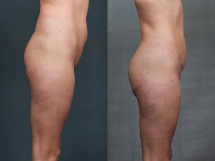 Brazilian Butt Lift Case 744 Before & After Right Side | Louisville, KY | CaloSpa® Rejuvenation Center