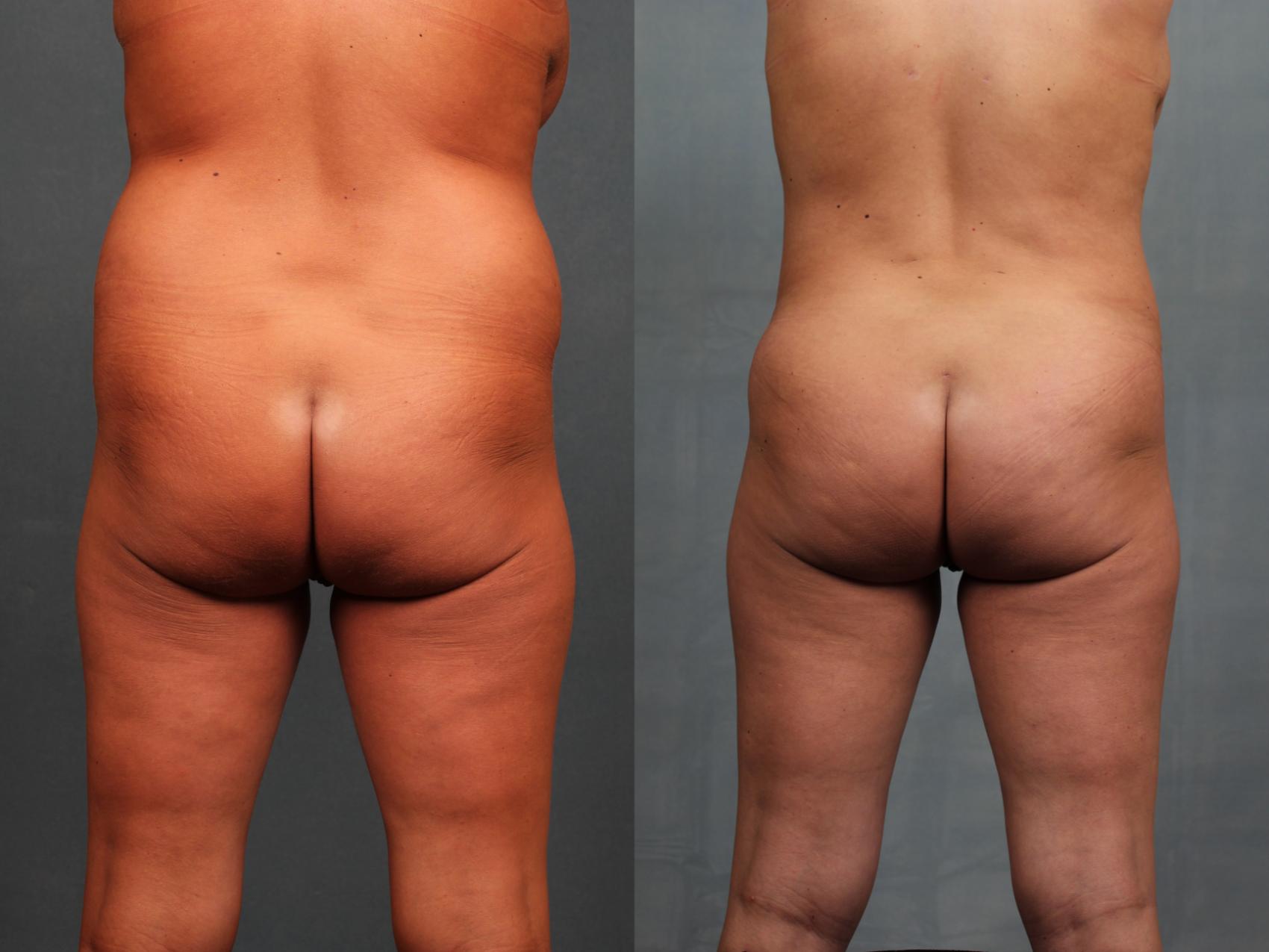Before & After Brazilian Butt Lift Case 745 Back View in Louisville & Lexington, KY