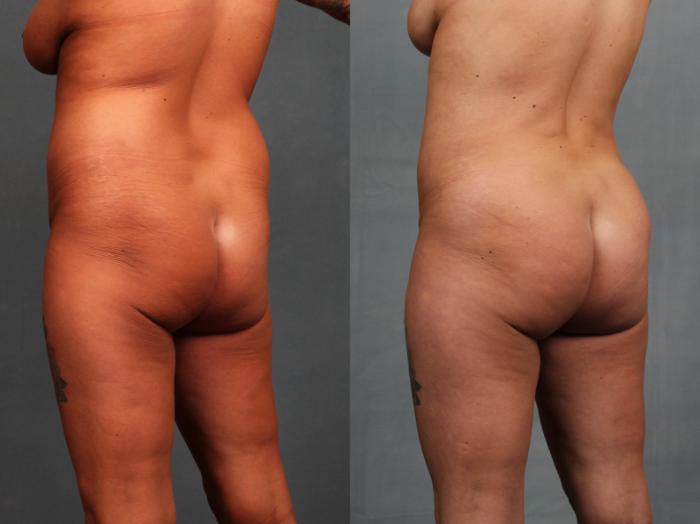 Before & After Brazilian Butt Lift Case 745 Left Oblique View in Louisville & Lexington, KY