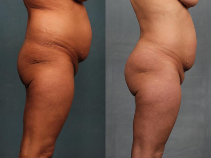 Before & After Brazilian Butt Lift Case 745 Right Side View in Louisville & Lexington, KY