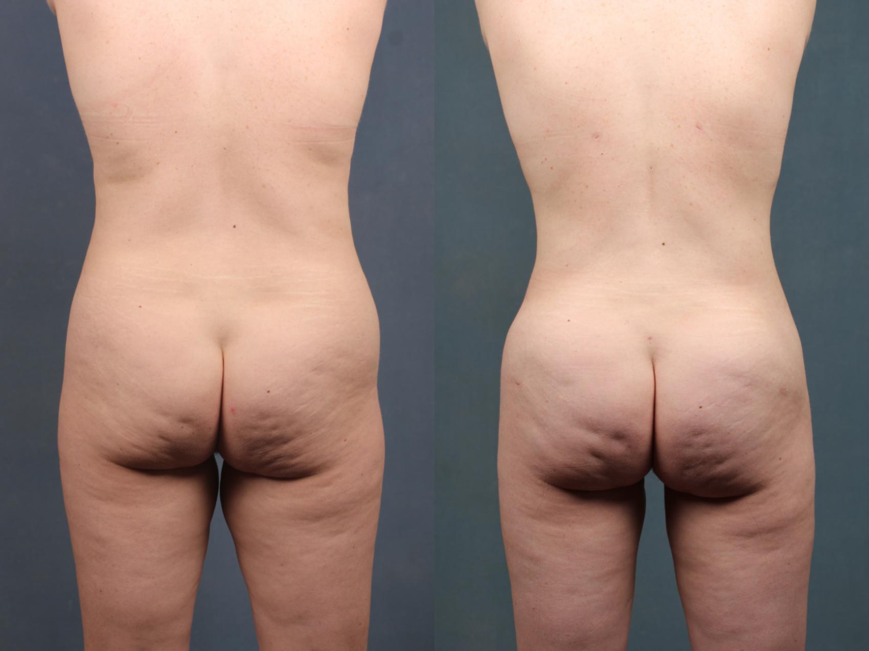 Before & After Brazilian Butt Lift Case 746 Back View in Louisville, KY