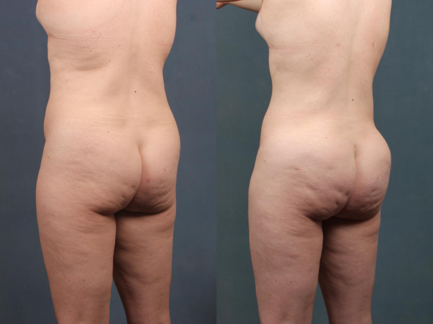 Before & After Brazilian Butt Lift Case 746 Left Oblique View in Louisville & Lexington, KY