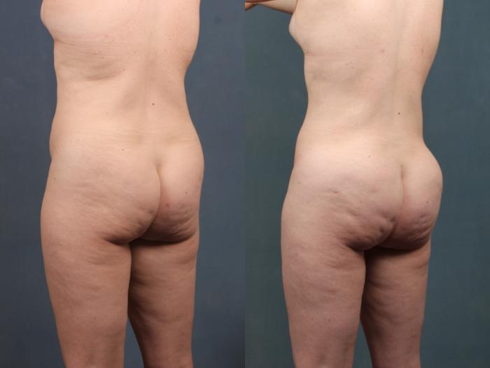 Brazilian Butt Lift Case 746 Before & After Left Oblique | Louisville, KY | CaloSpa® Rejuvenation Center