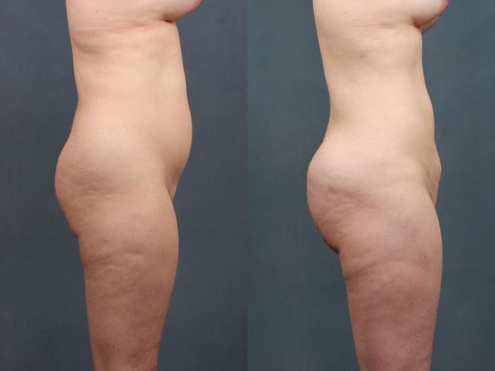 Before & After Brazilian Butt Lift Case 746 Right Side View in Louisville & Lexington, KY