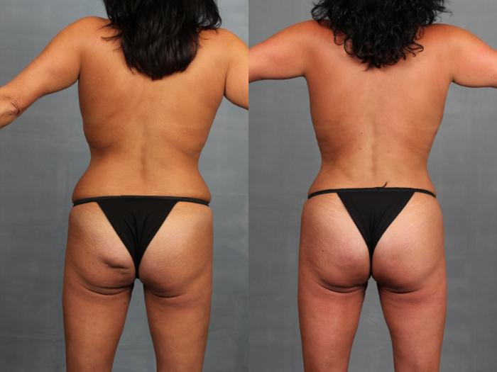 Before & After Brazilian Butt Lift Case 747 Back View in Louisville, KY
