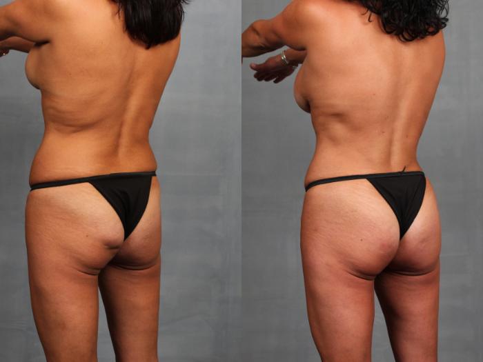 Before & After Brazilian Butt Lift Case 747 Left Oblique View in Louisville, KY