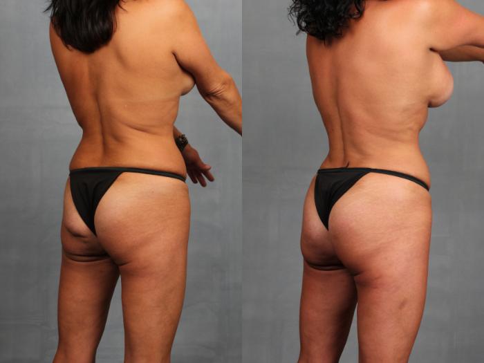 Before & After Brazilian Butt Lift Case 747 Right Oblique View in Louisville, KY