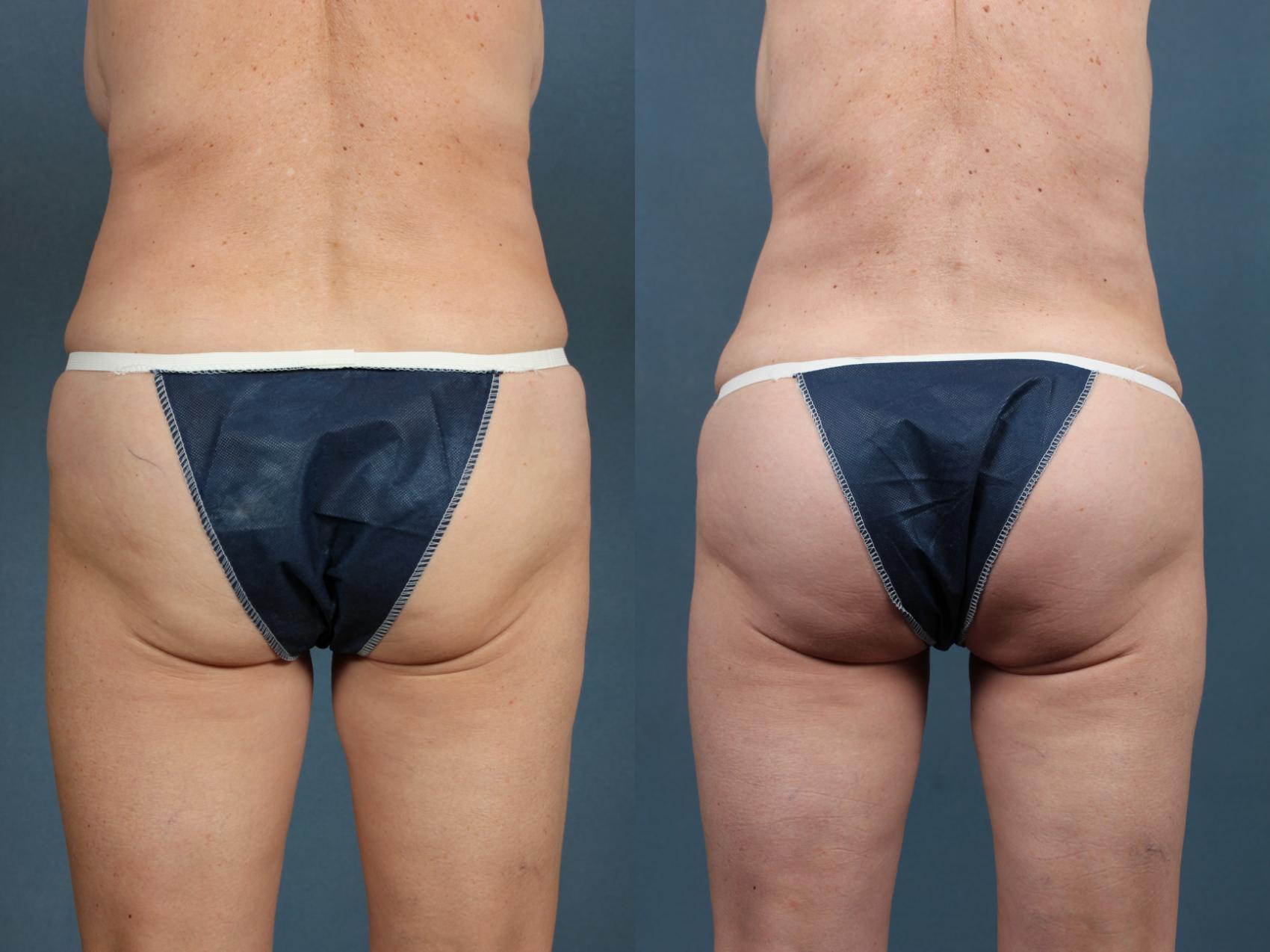 Before & After Brazilian Butt Lift Case 748 Back View in Louisville, KY