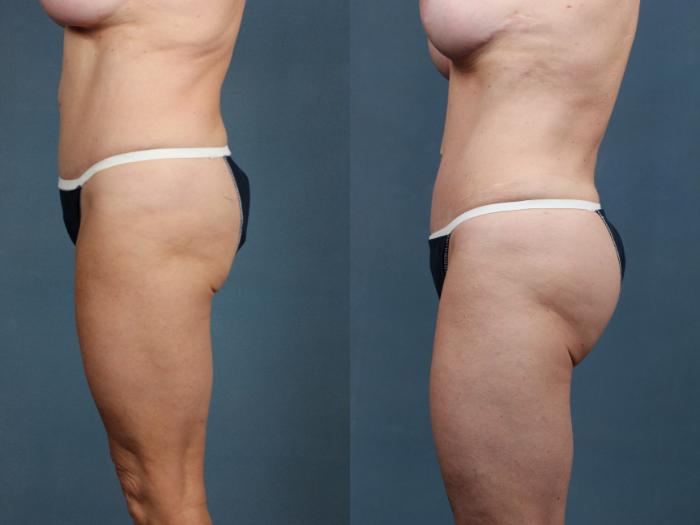 Brazilian Butt Lift Case 748 Before & After Left Side | Louisville, KY | CaloSpa® Rejuvenation Center