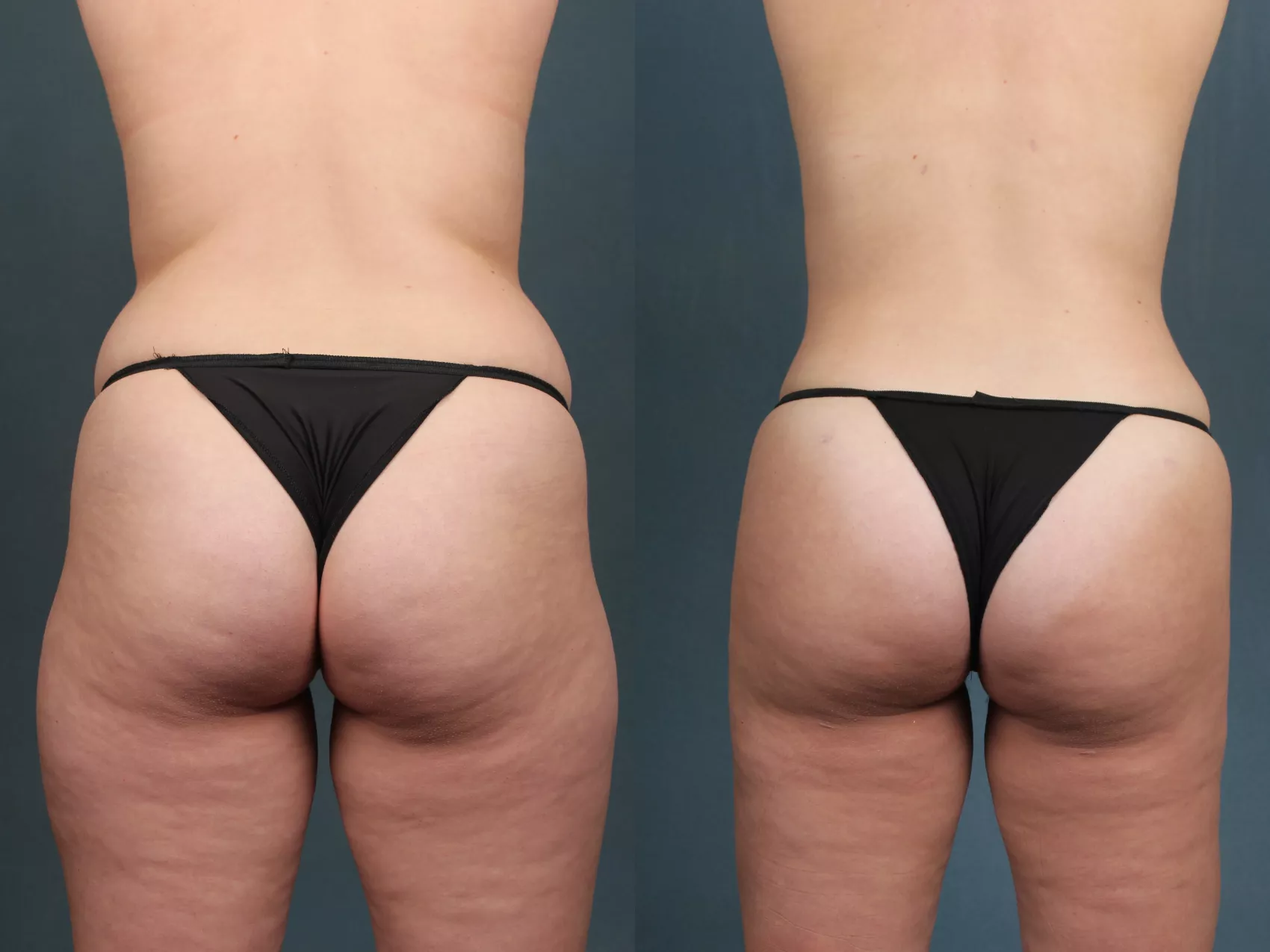 Patient #3957 Brazilian Butt Lift Before and After Photos Pomona - Plastic  Surgery Gallery Beverly Hills - Dr. Lee Au
