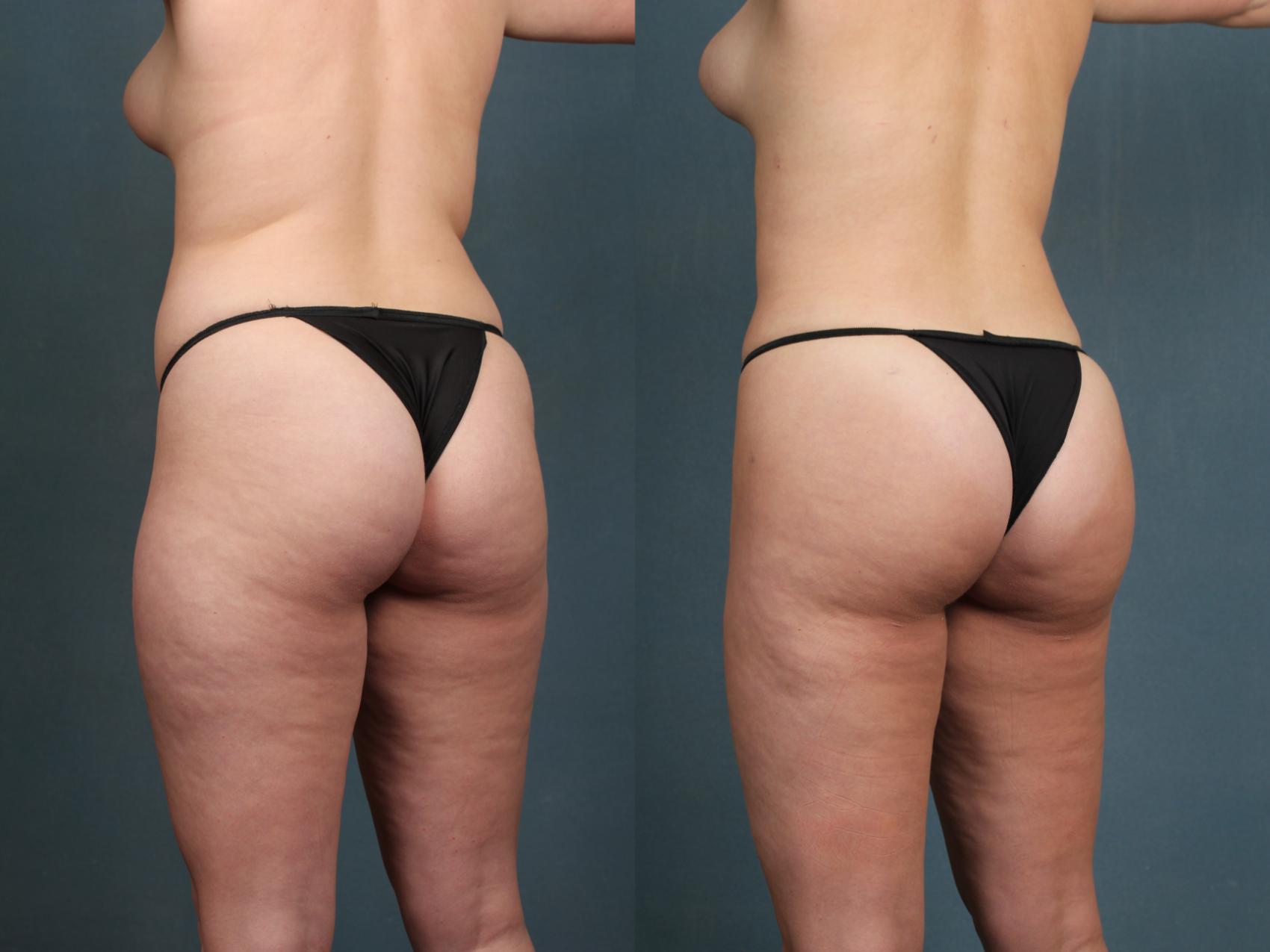CaloAesthetics Brazilian Butt Lift before and after photo